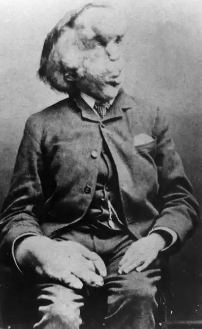 Watch and Download Joseph Merrick: The Real Elephant Man 2